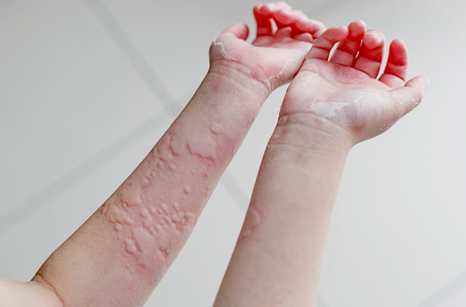 蕁麻疹 写真:皮膚の膨疹と赤みのイメージ